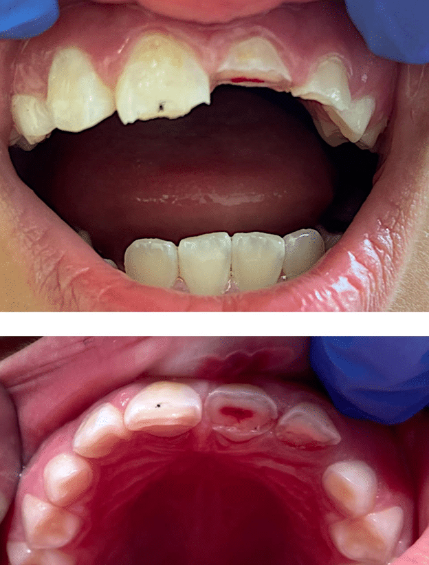 Chipped upper front teeth, dental examination
